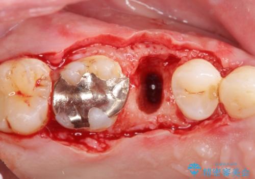 強い咬合力クリアランスの問題を解決したメタルボンドブリッジ治療の治療前