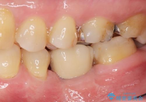 インプラントによる咬合機能回復の治療後