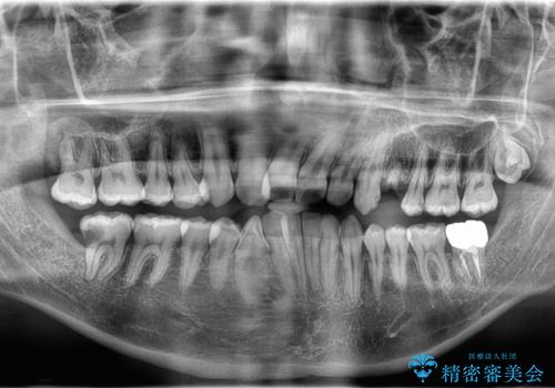 【インプラント】歯が無いので入れて欲しい!の治療前