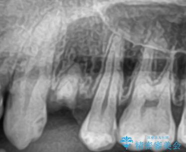 【インプラント】歯が無いので入れて欲しい!の治療前