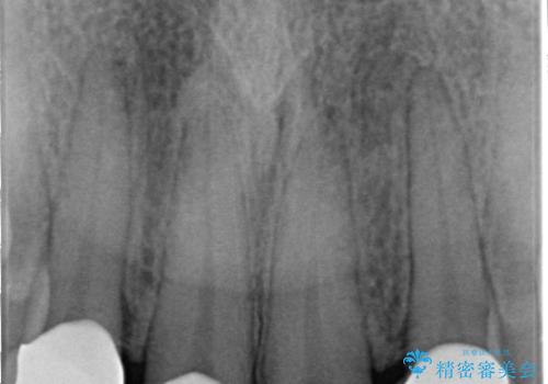 前歯の形気になる　セラミッククラウン(SP)の治療後