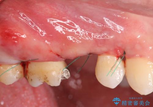 強い咬合力クリアランスの問題を解決したメタルボンドブリッジ治療の治療前