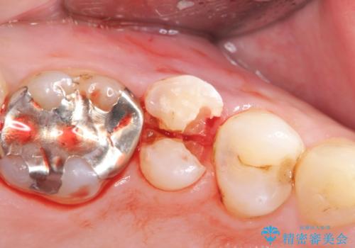 強い咬合力クリアランスの問題を解決したメタルボンドブリッジ治療の治療前
