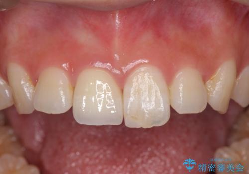 [ 前歯のセラミック治療 ]  変色した前歯を綺麗にしたいの治療後