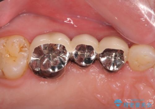 強い咬合力クリアランスの問題を解決したメタルボンドブリッジ治療の治療後