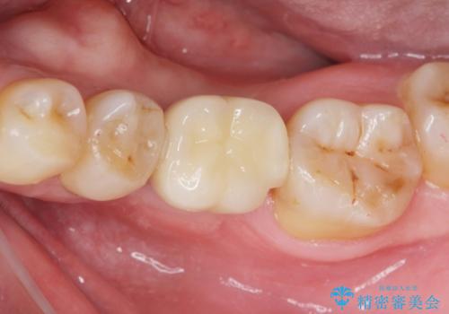 インプラントによる咬合機能回復の治療後