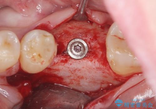 インプラントによる咬合機能回復の治療中