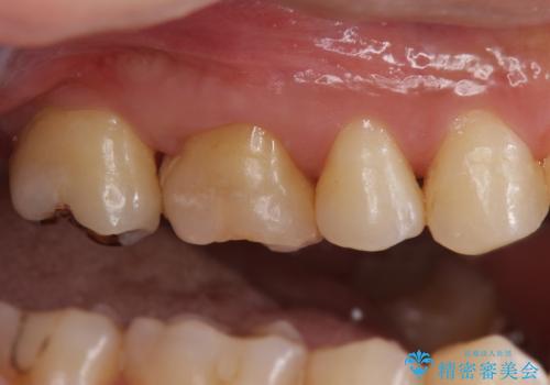 不適な樹脂の詰め物 被せ物で被覆の治療前