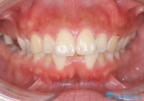 前歯の角度を改善するマウスピース矯正の症例 治療前