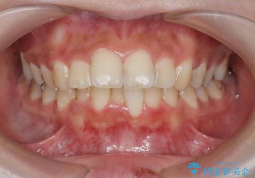 [ 出っ歯を治したい ]　マイクロインプラントを用いた大きな後方移動の症例 治療前