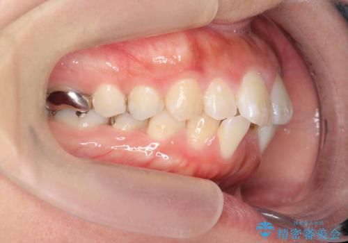 前歯の角度を改善するマウスピース矯正の治療前