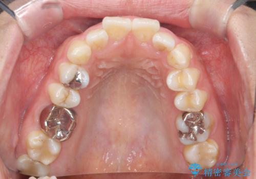前歯の角度を改善するマウスピース矯正の治療前