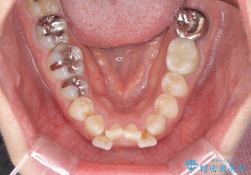 前歯の角度を改善するマウスピース矯正の治療前