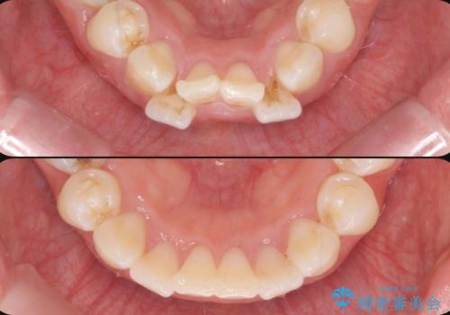 前歯の角度を改善するマウスピース矯正