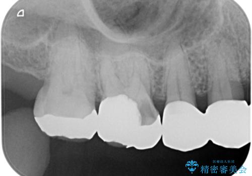 歯が欠けて染みるの治療前