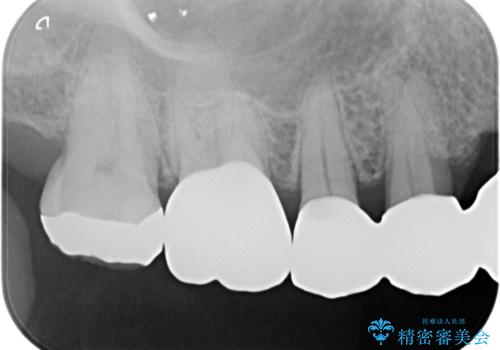 歯が欠けて染みるの治療後