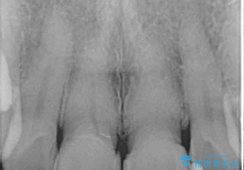 つぎはぎとグレーに透ける色が気になる 前歯のオールセラミッククラウン治療の治療前