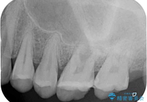 割れてしまった奥歯 サイナスリフトによるインプラント補綴治療の治療前