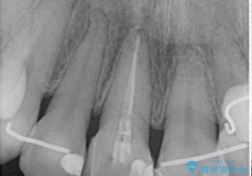 失活により変色した前歯 オールセラミッククラウンによる審美歯科治療の治療前