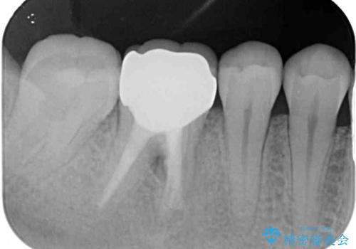 奥歯のむし歯を治したい セラミッククラウンによる補綴治療の治療後