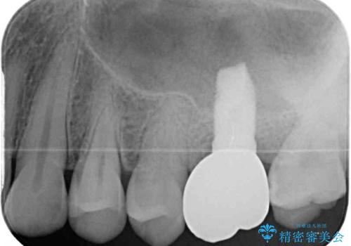 割れてしまった奥歯 サイナスリフトによるインプラント補綴治療の治療後