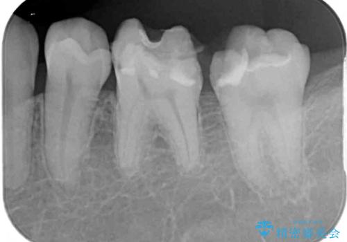 仮詰めのまま処置が進まないので転院　奥歯のむし歯治療の治療前
