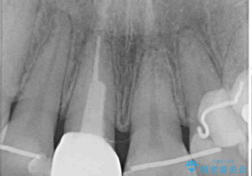 失活により変色した前歯 オールセラミッククラウンによる審美歯科治療の治療後