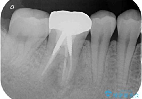 奥歯のむし歯を治したい セラミッククラウンによる補綴治療の治療前