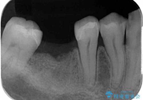 失った歯のインプラント補綴の治療前