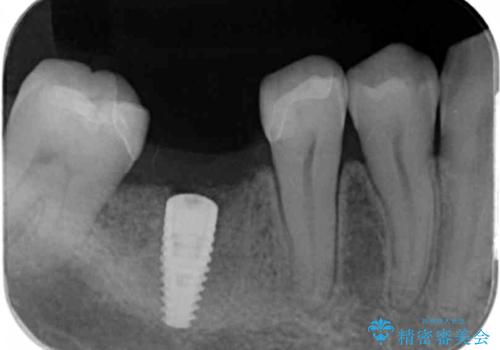 失った歯のインプラント補綴の治療中