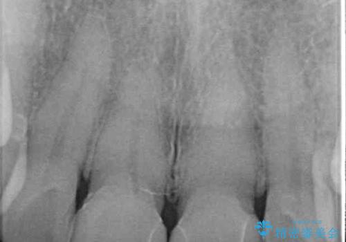 つぎはぎとグレーに透ける色が気になる 前歯のオールセラミッククラウン治療の治療後