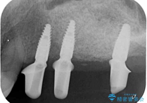 [ 重度歯周病 ]　抜歯後のインプラント治療の治療中