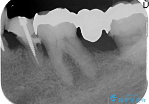 [ 重度歯周病 ]　抜歯後のインプラント治療の治療前