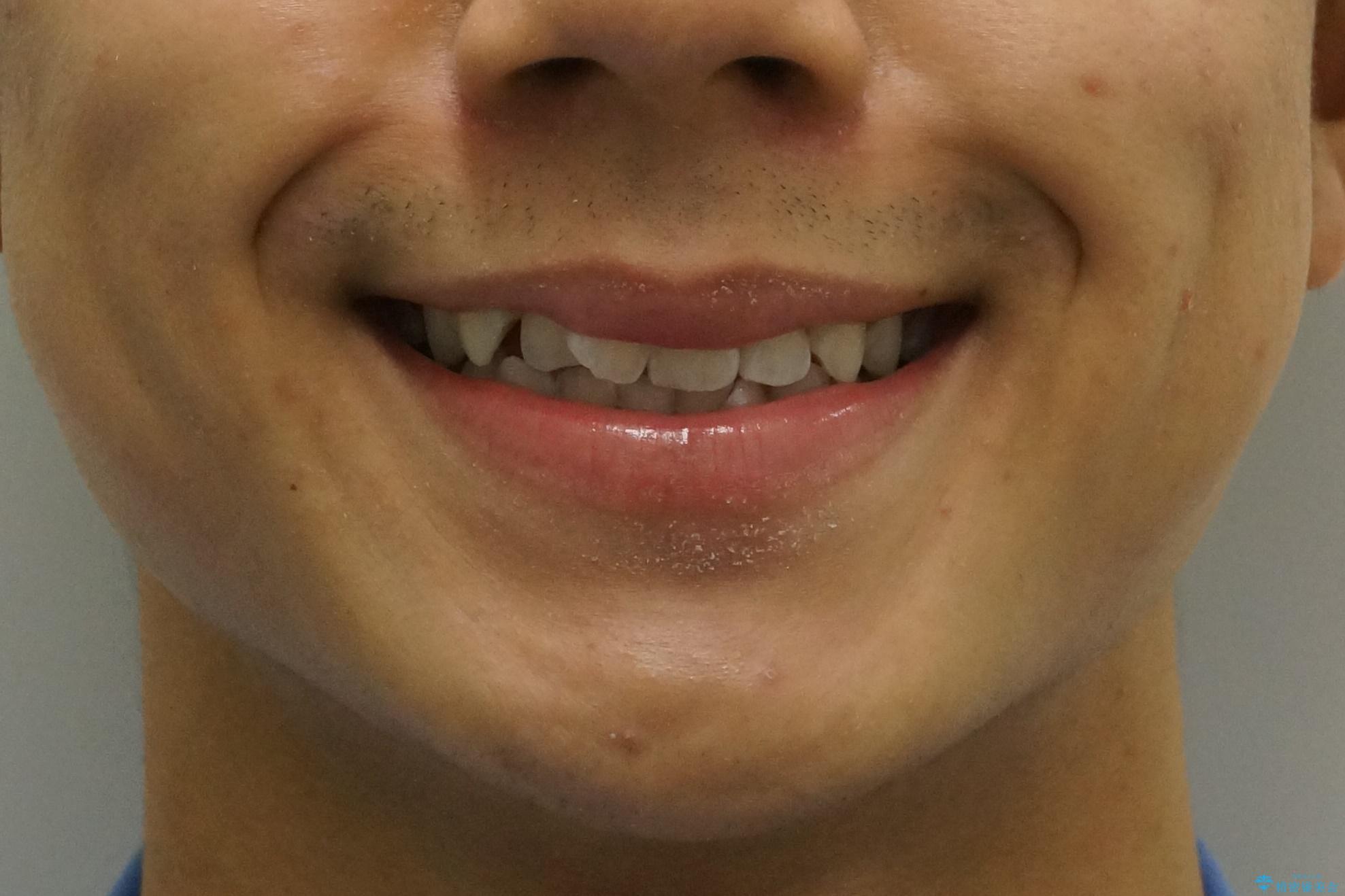 前歯のがたつき 1年かからず治療 マウスピース矯正の治療前(顔貌)