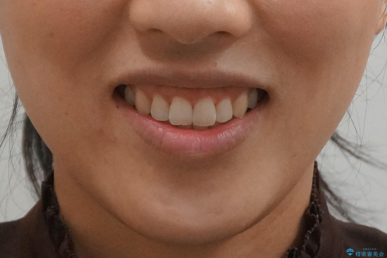 下の前歯のがたつき　インビザラインでの治療後（顔貌）