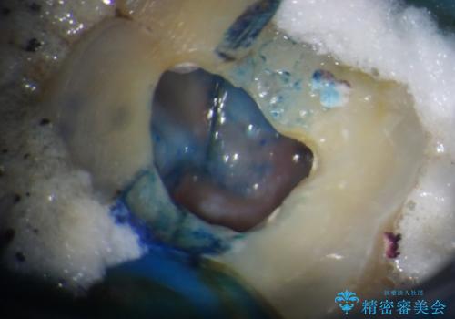 割れてしまった奥歯 サイナスリフトによるインプラント補綴治療の治療前