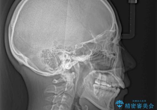 残存乳歯とオープンバイト インビザラインによる矯正治療の治療前