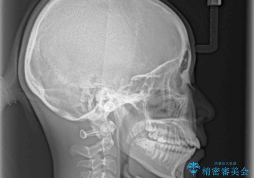 口元の突出感を抜歯矯正で改善 メタル装置で費用を抑えるの治療前