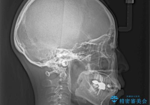 ワイヤー装置の抜歯矯正で横顔の口元の印象をすっきりとの治療前