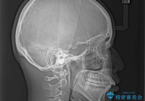 閉じにくい口元を抜歯矯正ですっきりとの治療前