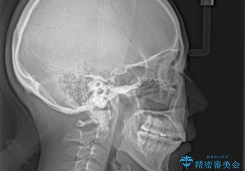 残存乳歯とオープンバイト インビザラインによる矯正治療の治療後