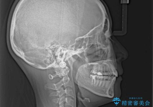 口元の突出感を抜歯矯正で改善 メタル装置で費用を抑えるの治療後