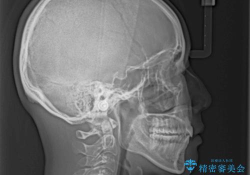 閉じにくい口元を抜歯矯正ですっきりとの治療後