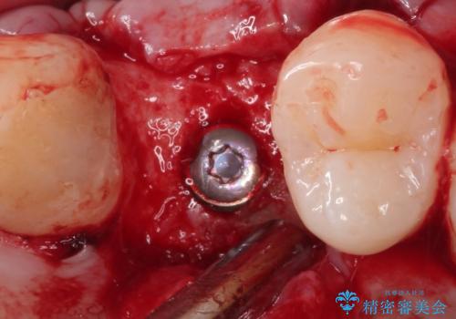 【インプラント】歯が無いので入れて欲しい!の治療中