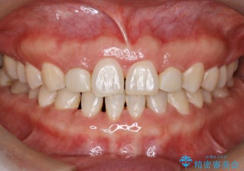 歯の形気になる!! セラミック治療 前歯( エクセレント)の治療前