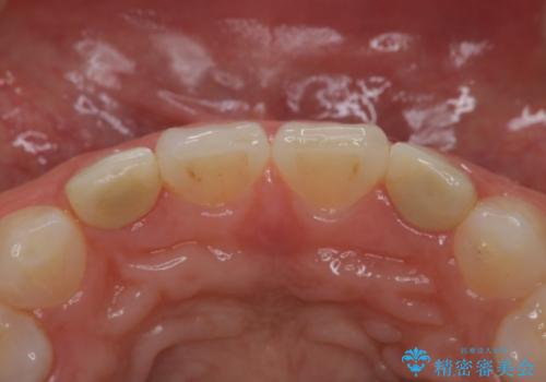 歯の形気になる!! セラミック治療 前歯( エクセレント)の治療前