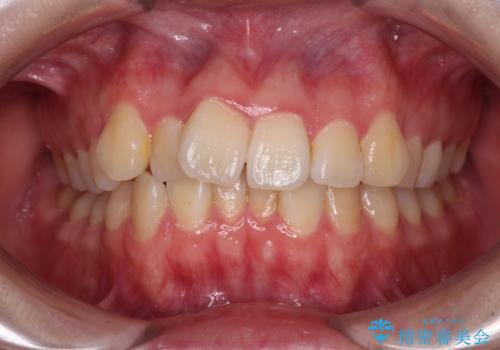 【モニター】八重歯を片側の抜歯矯正で治す メタルブラケット装置の症例 治療前