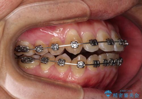 前歯のデコボコを費用を抑えたメタルブラケットできれいにの治療中