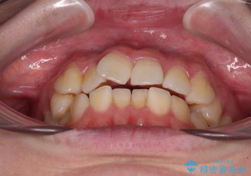 【モニター】八重歯を片側の抜歯矯正で治す メタルブラケット装置の治療前