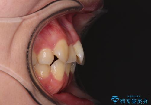 【モニター】八重歯を片側の抜歯矯正で治す　メタルブラケット装置の治療前